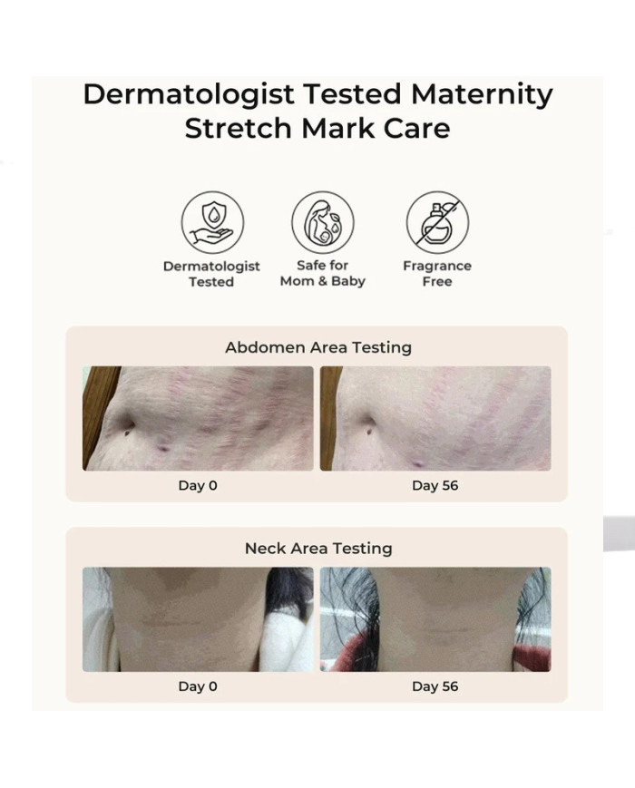 Dermatologiškai patikrinto kremo naudojimo rezultatų palyginimas pilvo ir kaklo srityse po 56 dienų